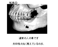 通常の人の骨です。矢印先の丸く見えているのが下顎の中にある下歯槽神経の出口（オトガイ孔）です